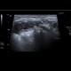 Sialolithiasis, salivary stone, submandibular gland, Wharton's duct: US - Ultrasound